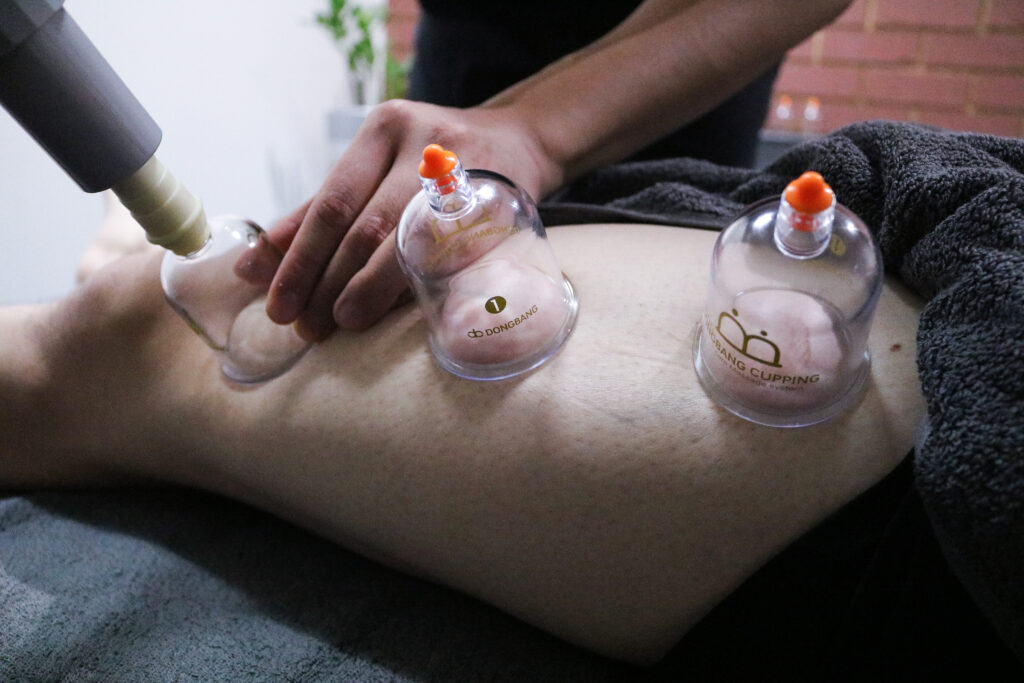 MYOFASCIAL CUPPING