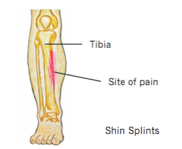 Shin Splints - Wiltshire Osteopathy